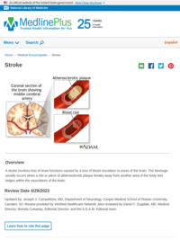 Stroke: Illustration of Blocked Blood Vessel